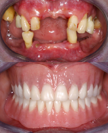 image of full arch implant case study